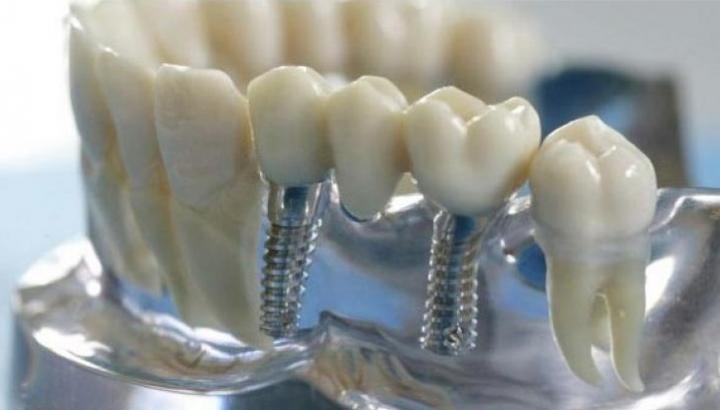 Implantáció
